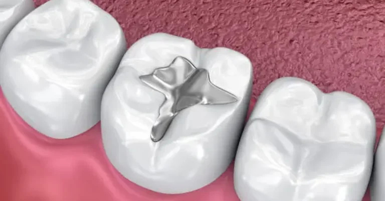 how long does a fill take