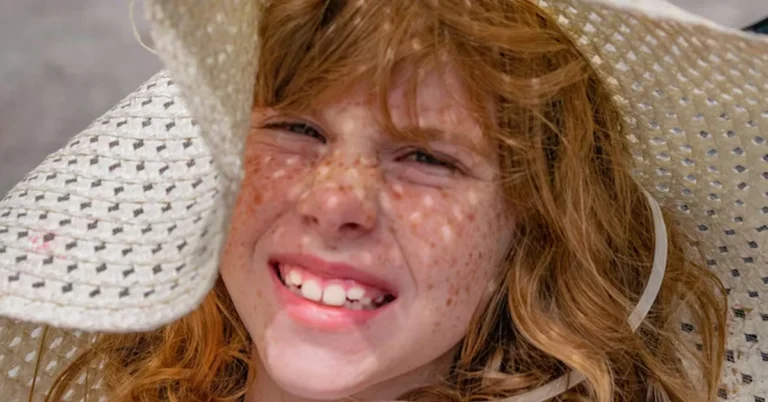 how to eliminate freckles