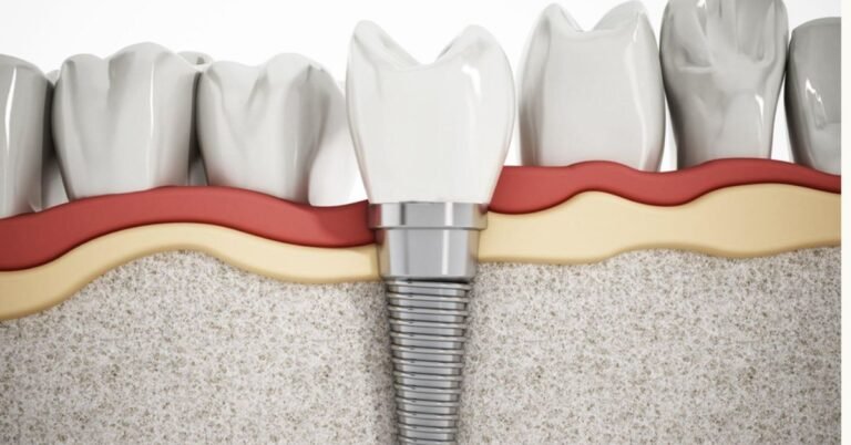Dental Implant Procedures