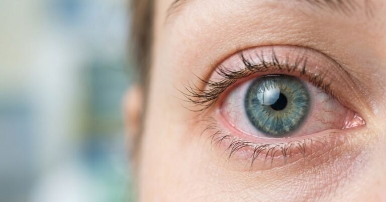 Bloodshot Eyes